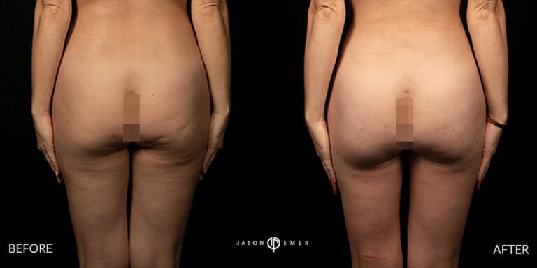 FAT GRAFTING GALLERY 01