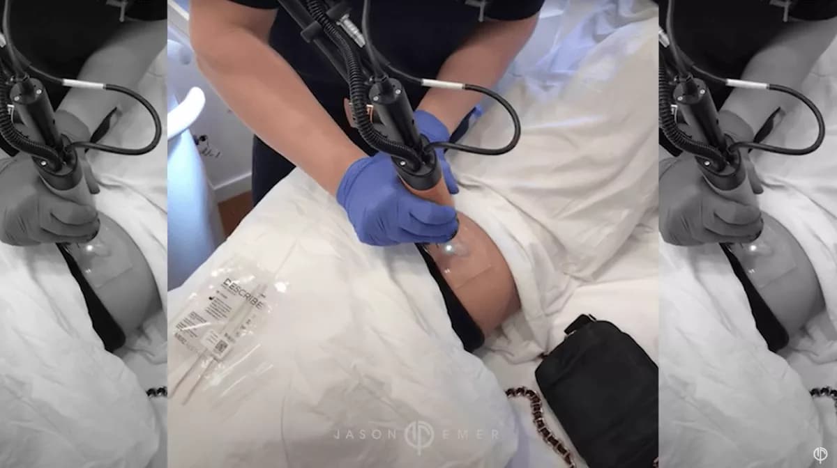 Laser dermatology treatment