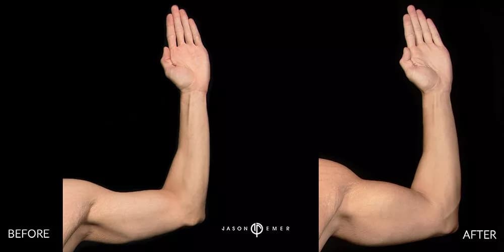 Editorial before-and-after arm contour after arm lift and tightening