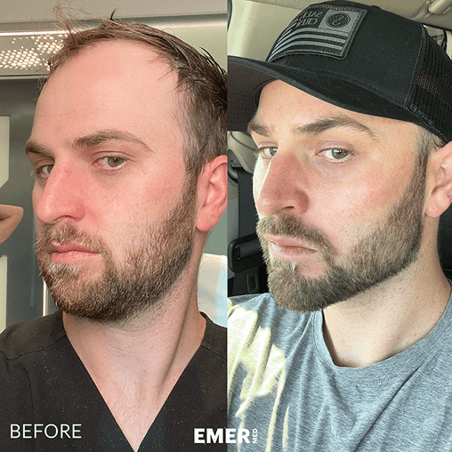 Male facial sculpting result reference