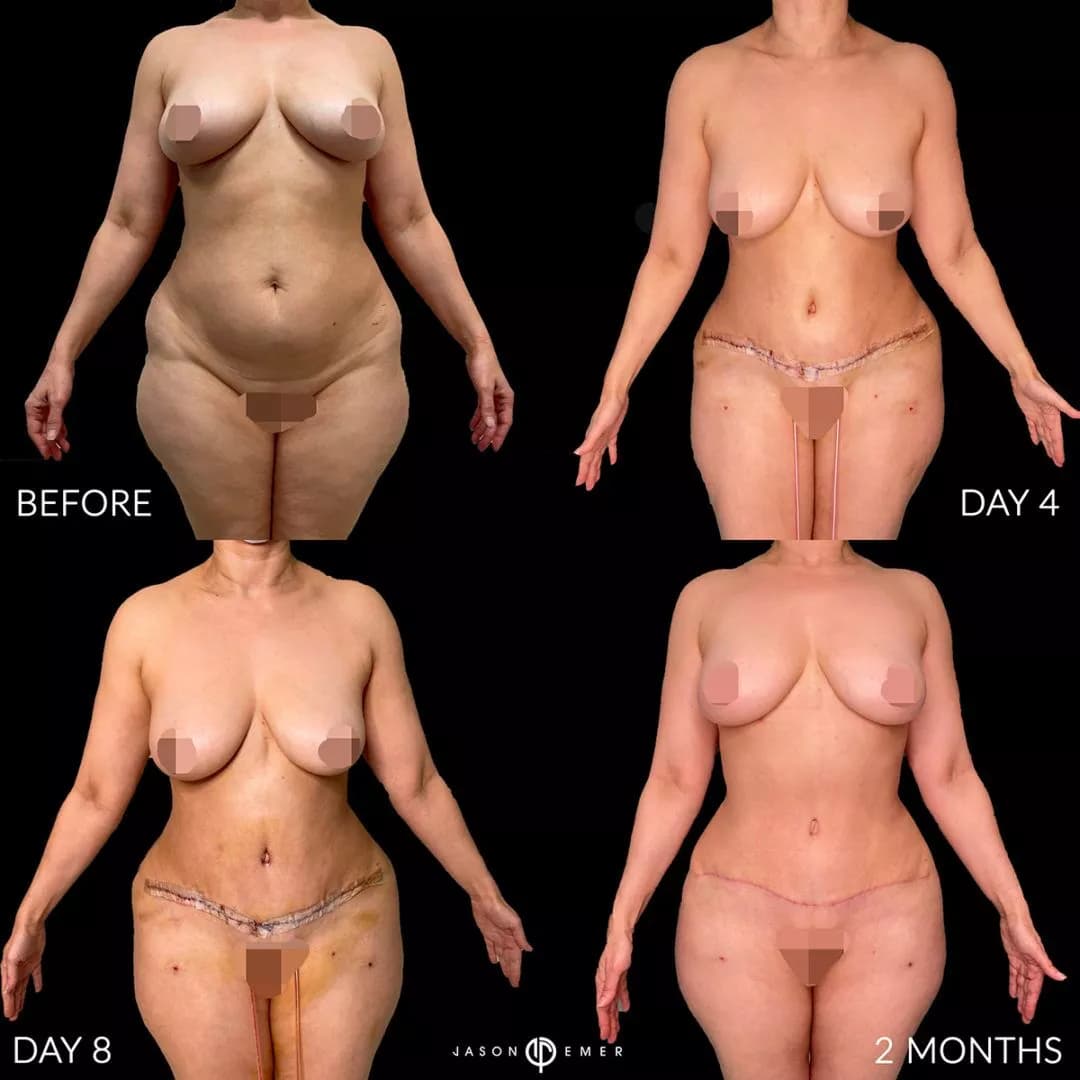 Editorial mommy makeover progression — before, day 4, day 8, two months