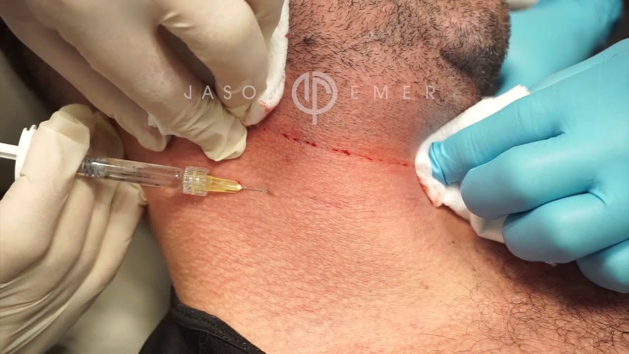 Watch a rejuvenating dermal fillers procedure video