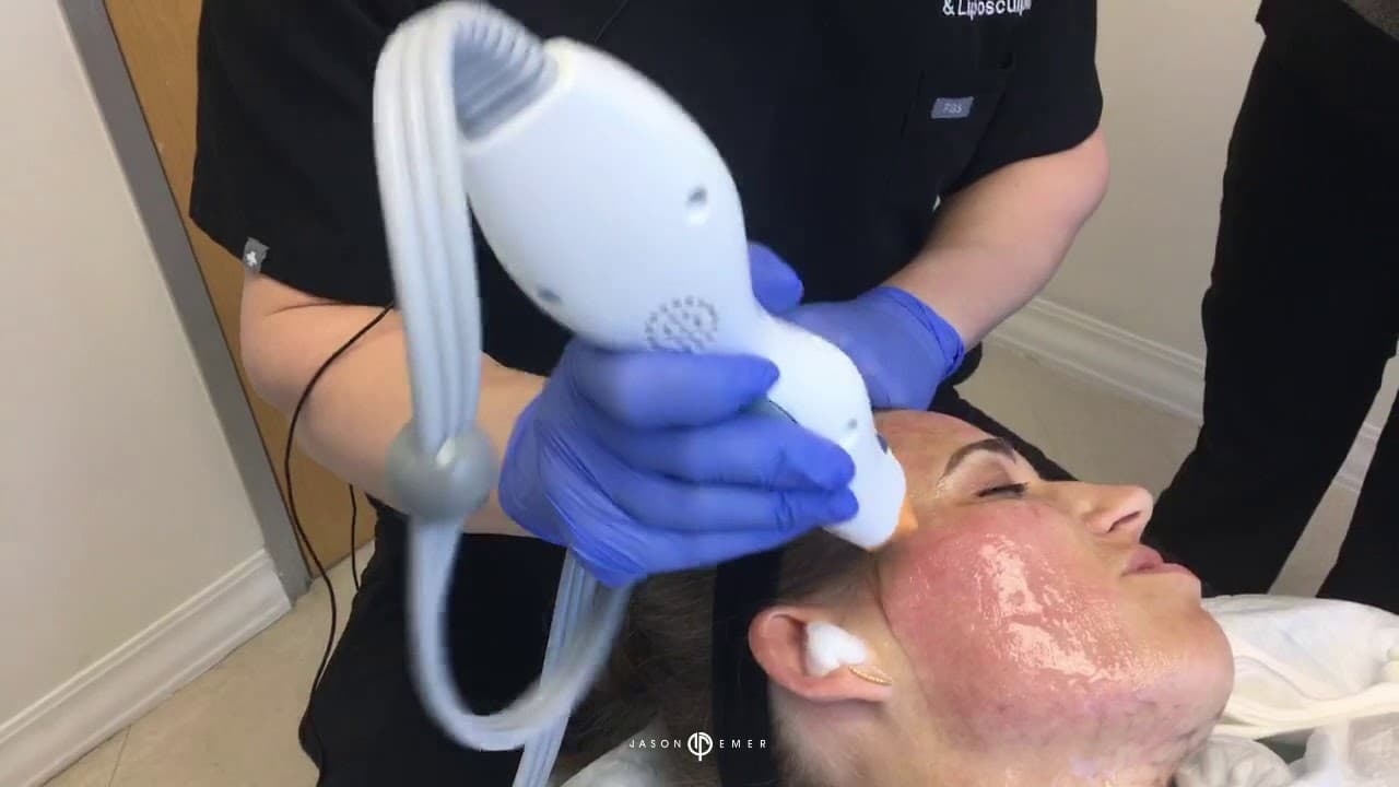 Watch a thermage non-surgical radiofrequency therapy procedure video