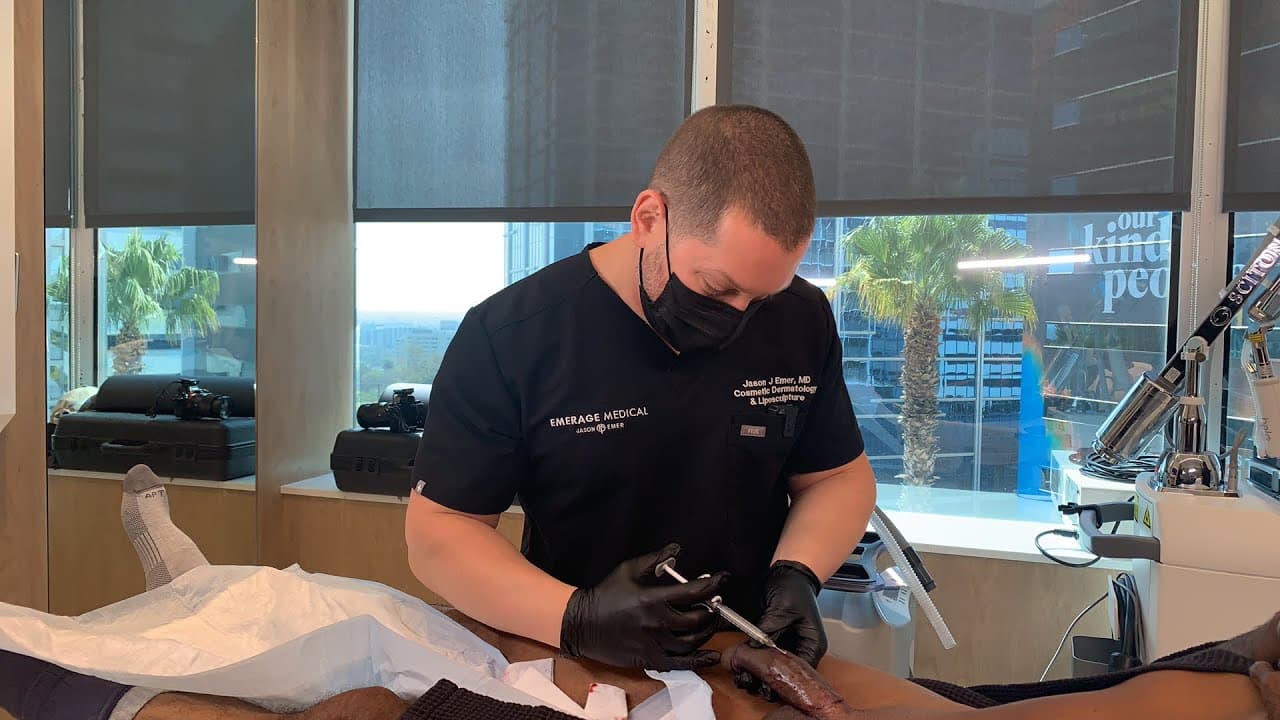 Male rejuvenation — Bellafill case study
