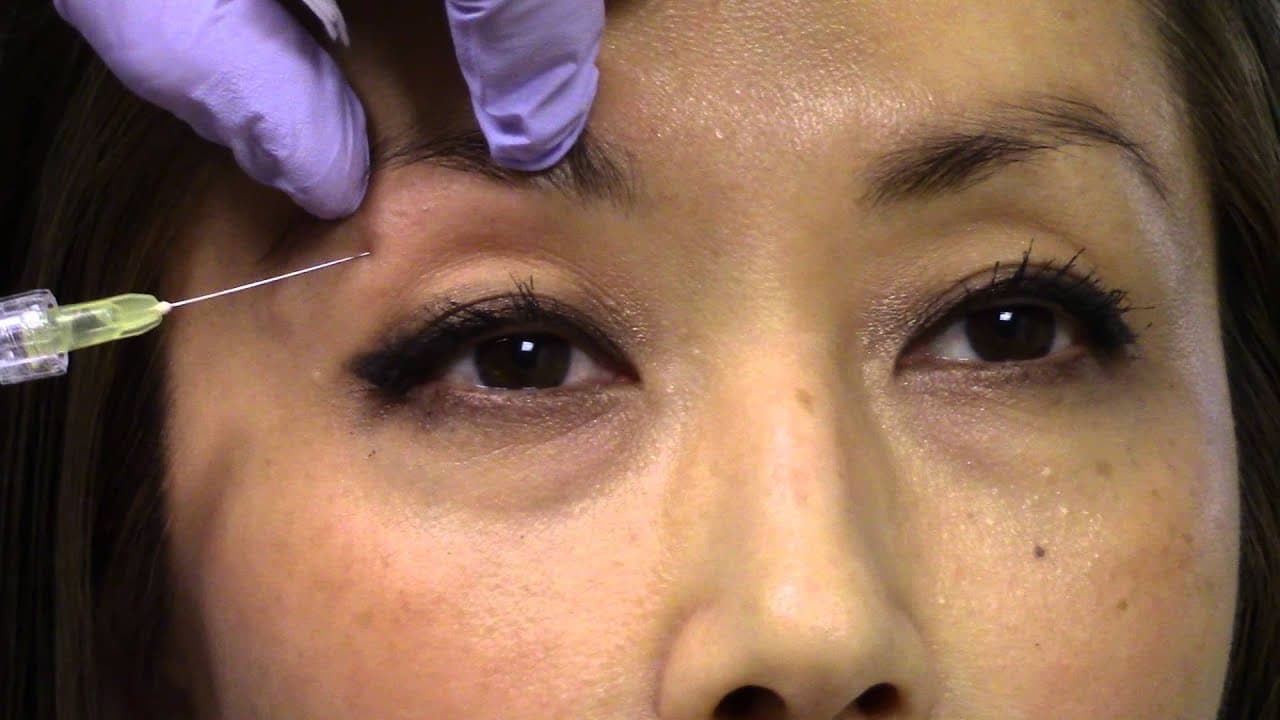 Watch a thermage non-surgical radiofrequency therapy procedure video