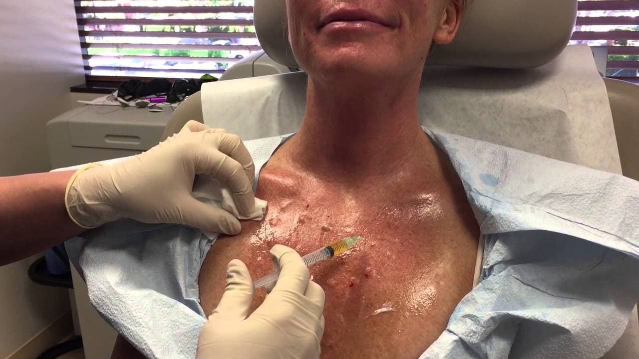 Watch a rejuvenating dermal fillers procedure video
