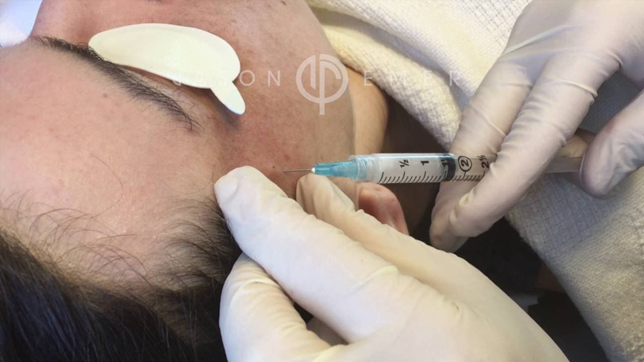 Watch a temple augmentation procedure video