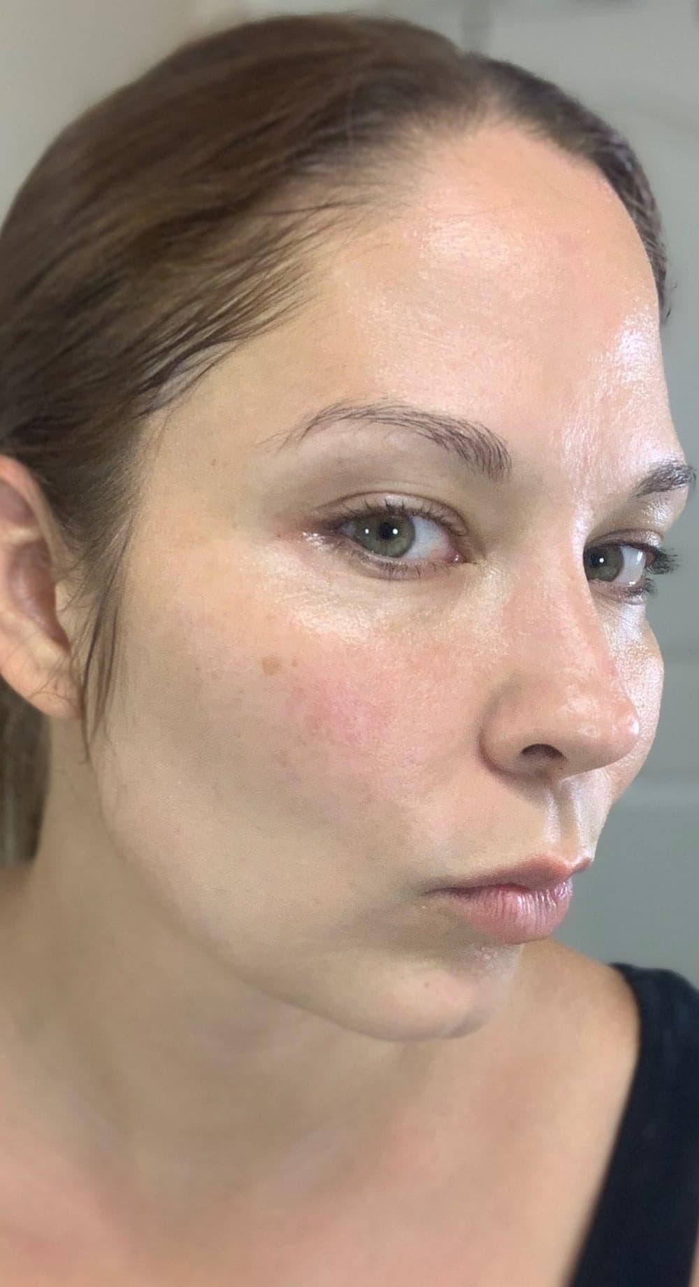 CELESTA Facial Sculpting — Before