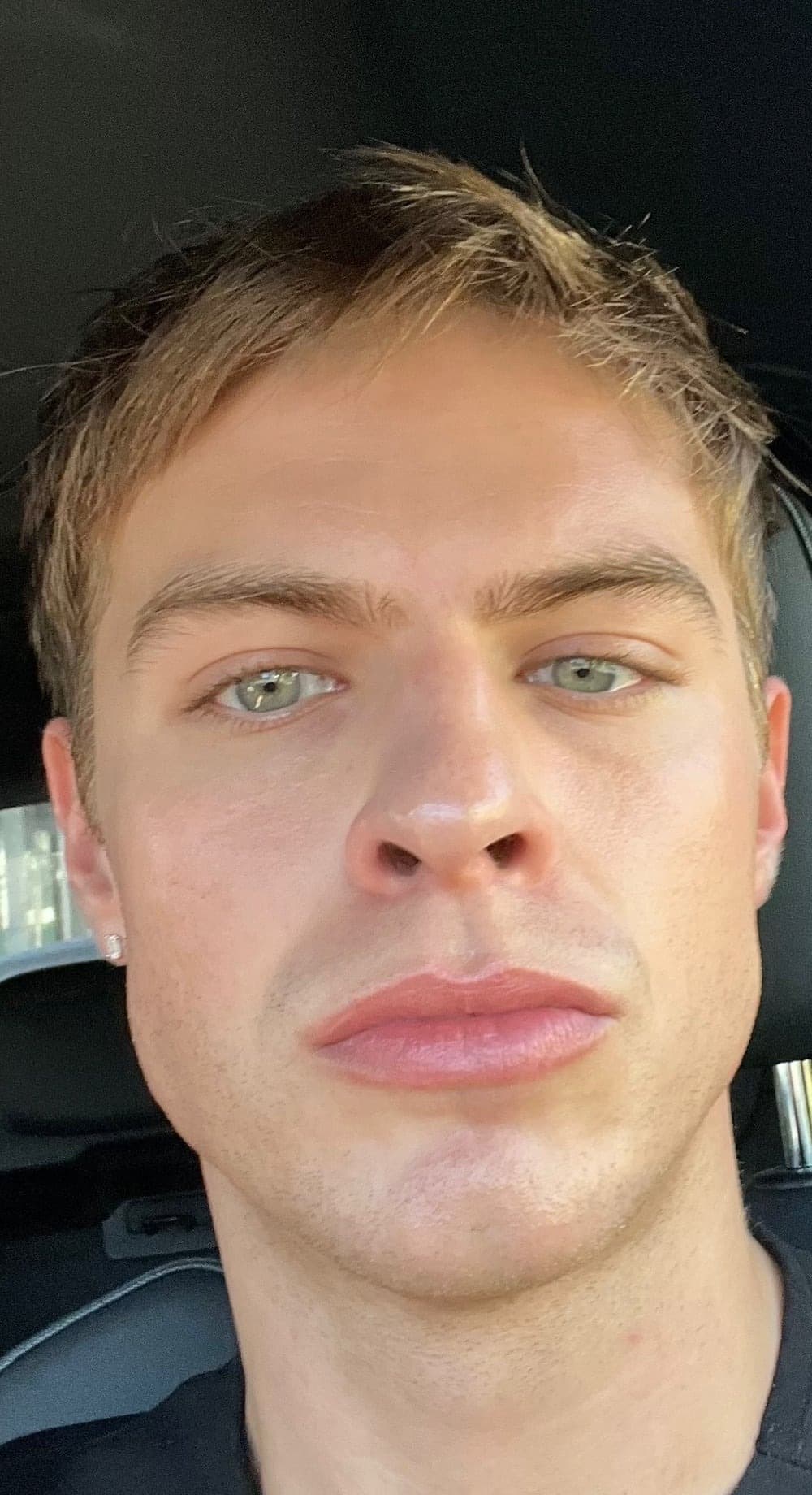 MAXORIS Facial Sculpting — After