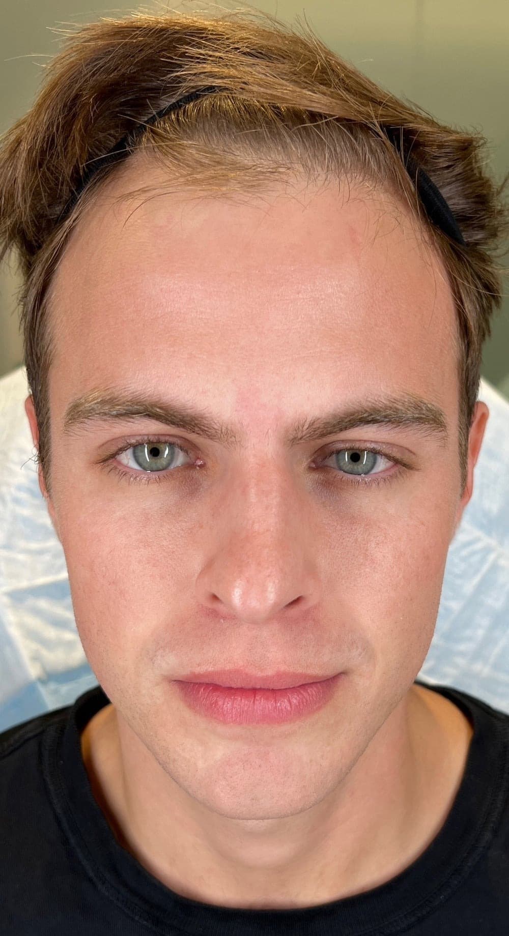 MAXORIS Facial Sculpting — Before