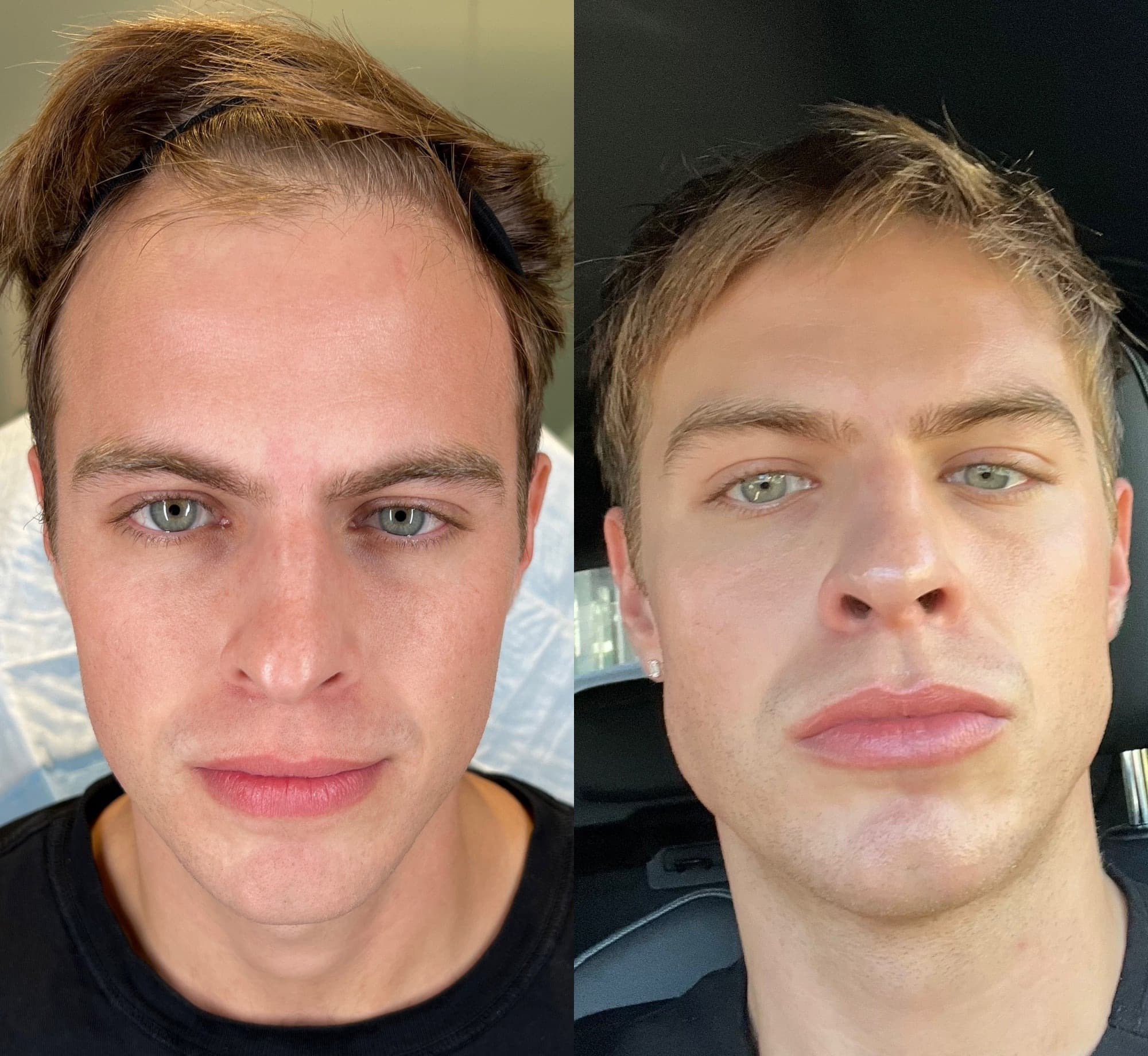 MAXORIS™ Face Before and After