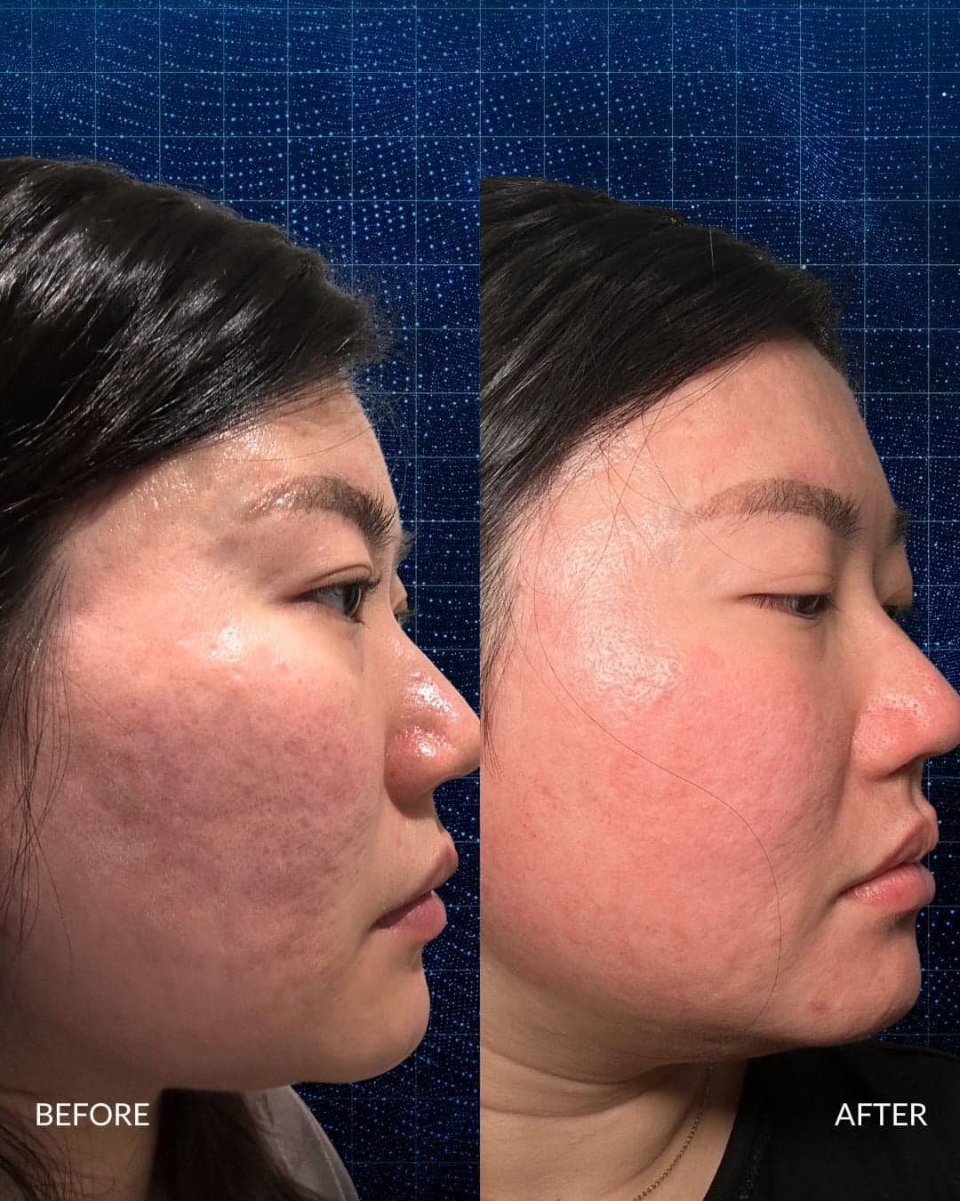 Acne Scar Reconstruction Before and After