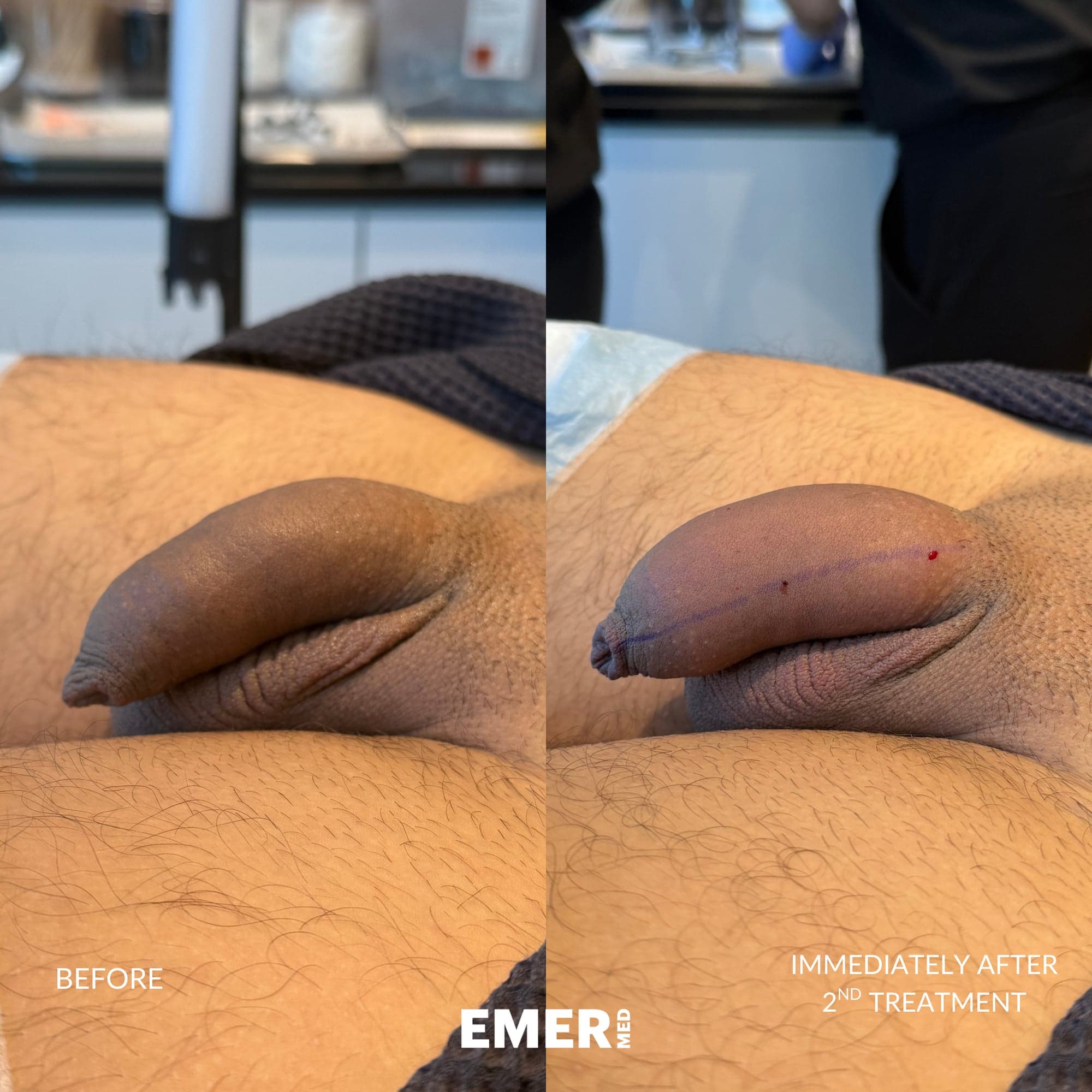 Male Enhancement — before and after