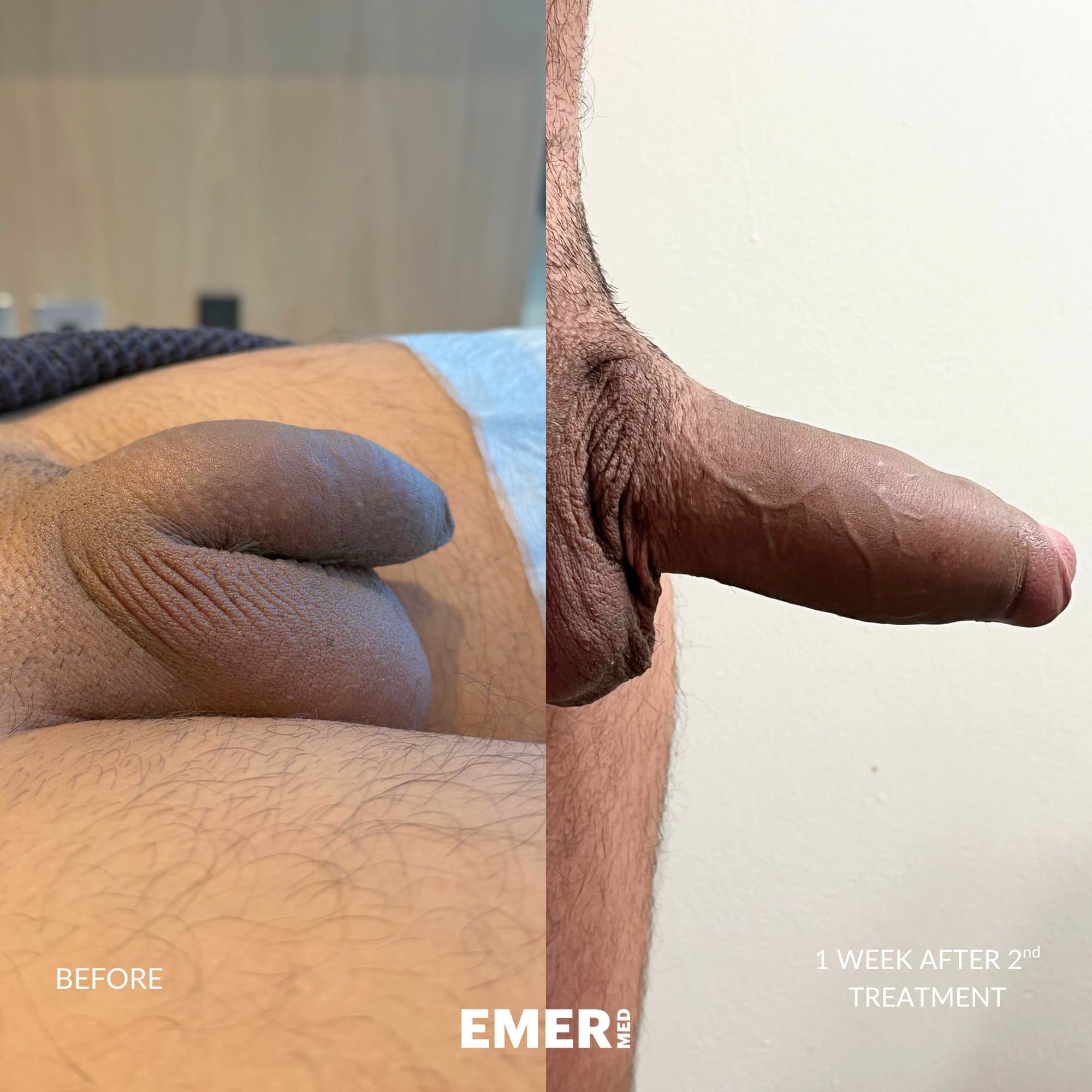 Male Enhancement — before and after