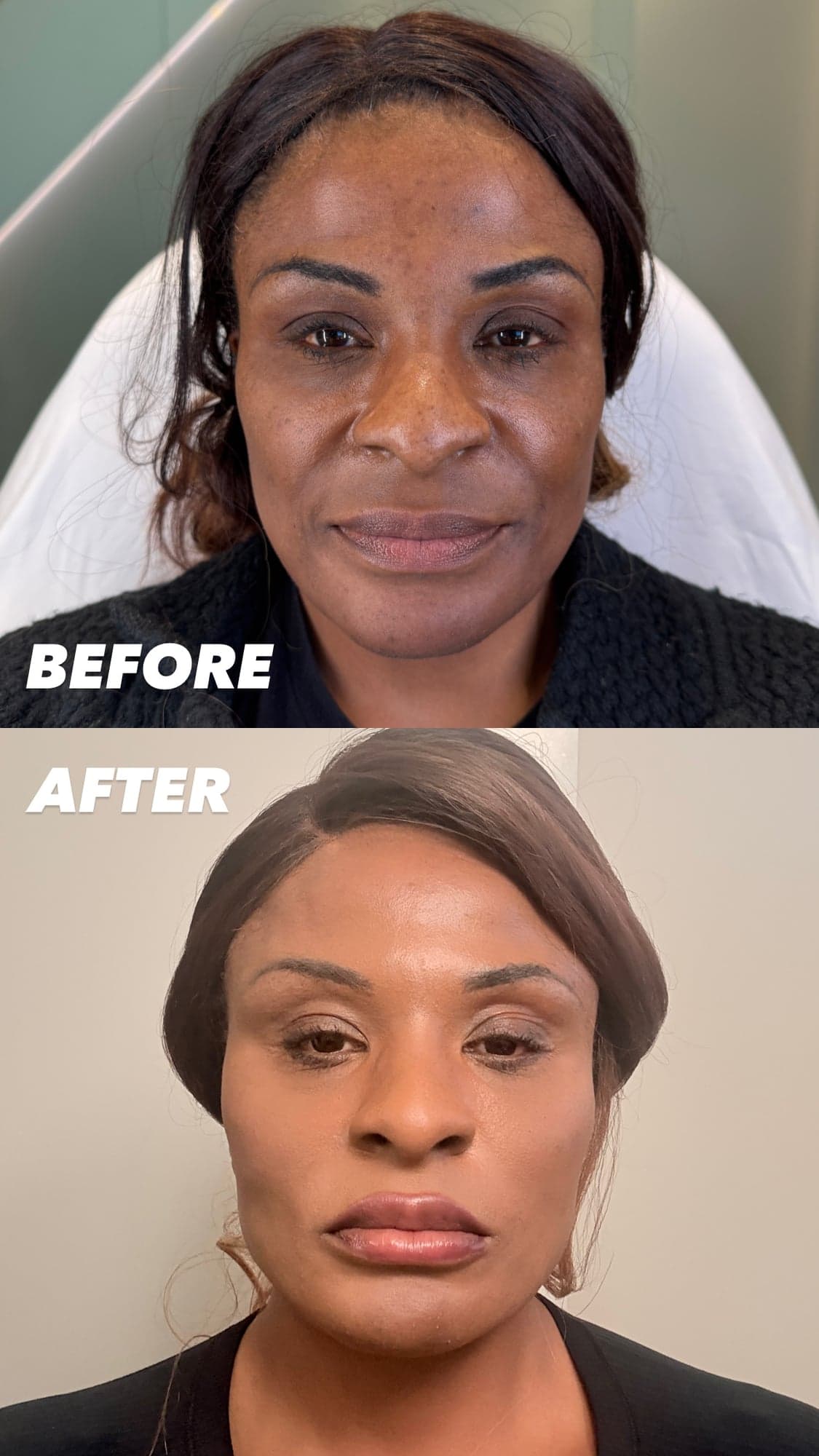 Female Facial Sculpting Before and After