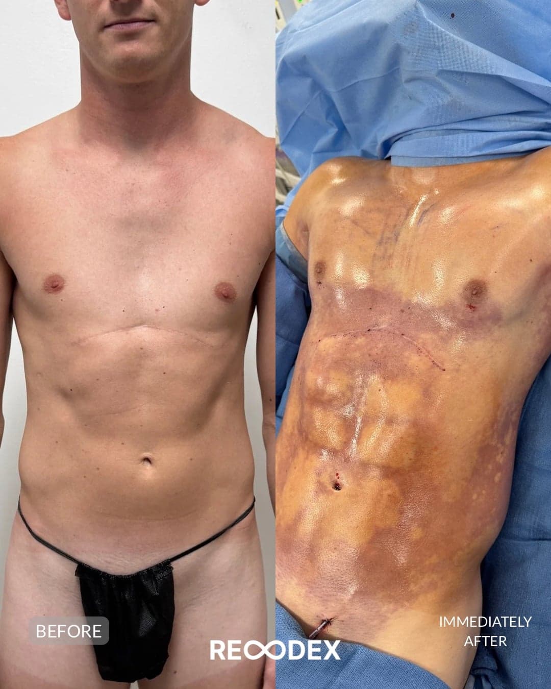 HD Body Sculpting & Implants Before and After