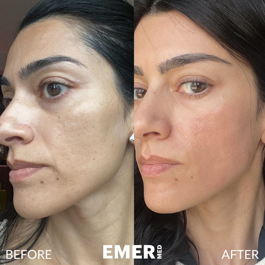 Acne Scar Treatment Before and After