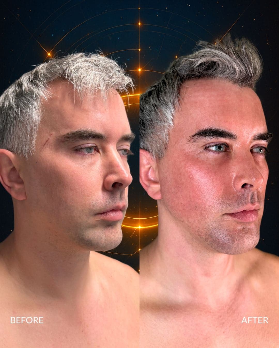 Male Facial Sculpting Before and After