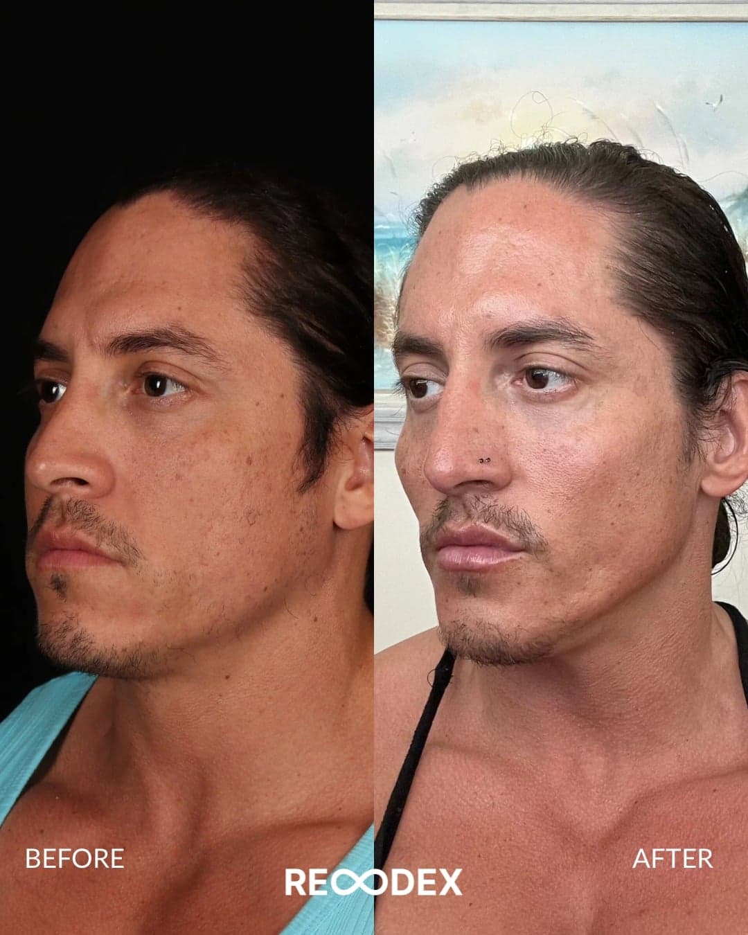 Male Facial Sculpting Before and After