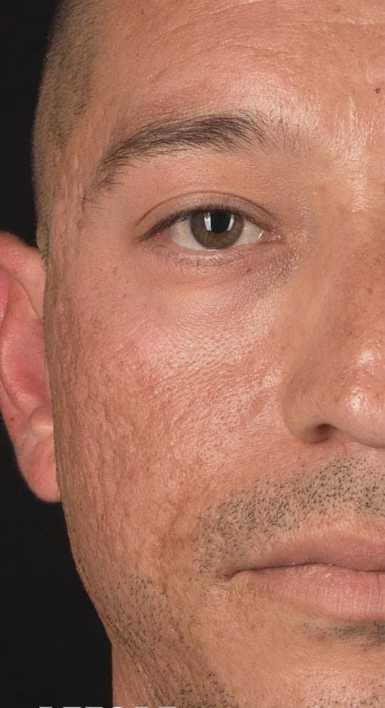 RE:SKN Acne Scars Treatment — Before