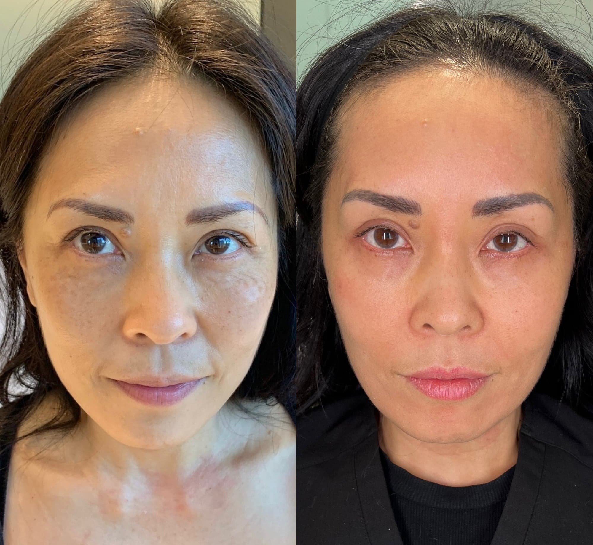 AETHRAFORM™ Reconstruction Before and After