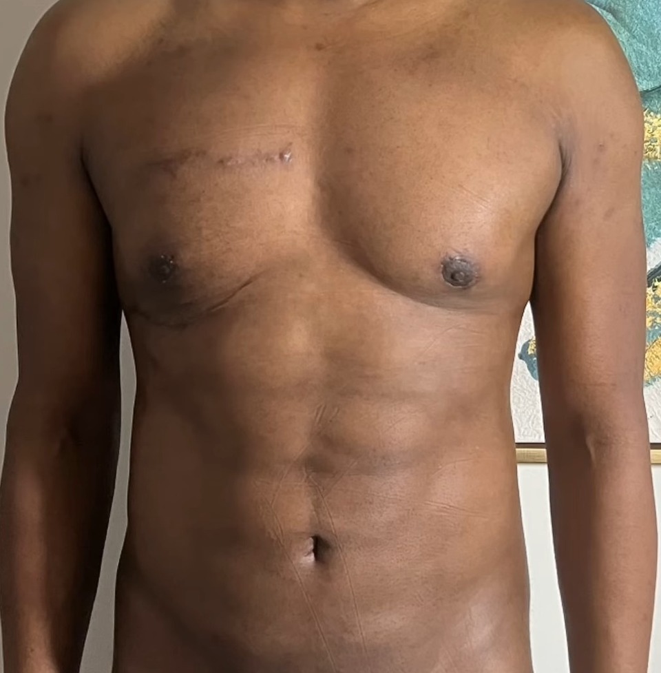 DAY 1, Revision Body Sculpting For Men: How Dr. Emer Fixes Previous Liposuction That Missed The Mark | Dr. Jason Emer