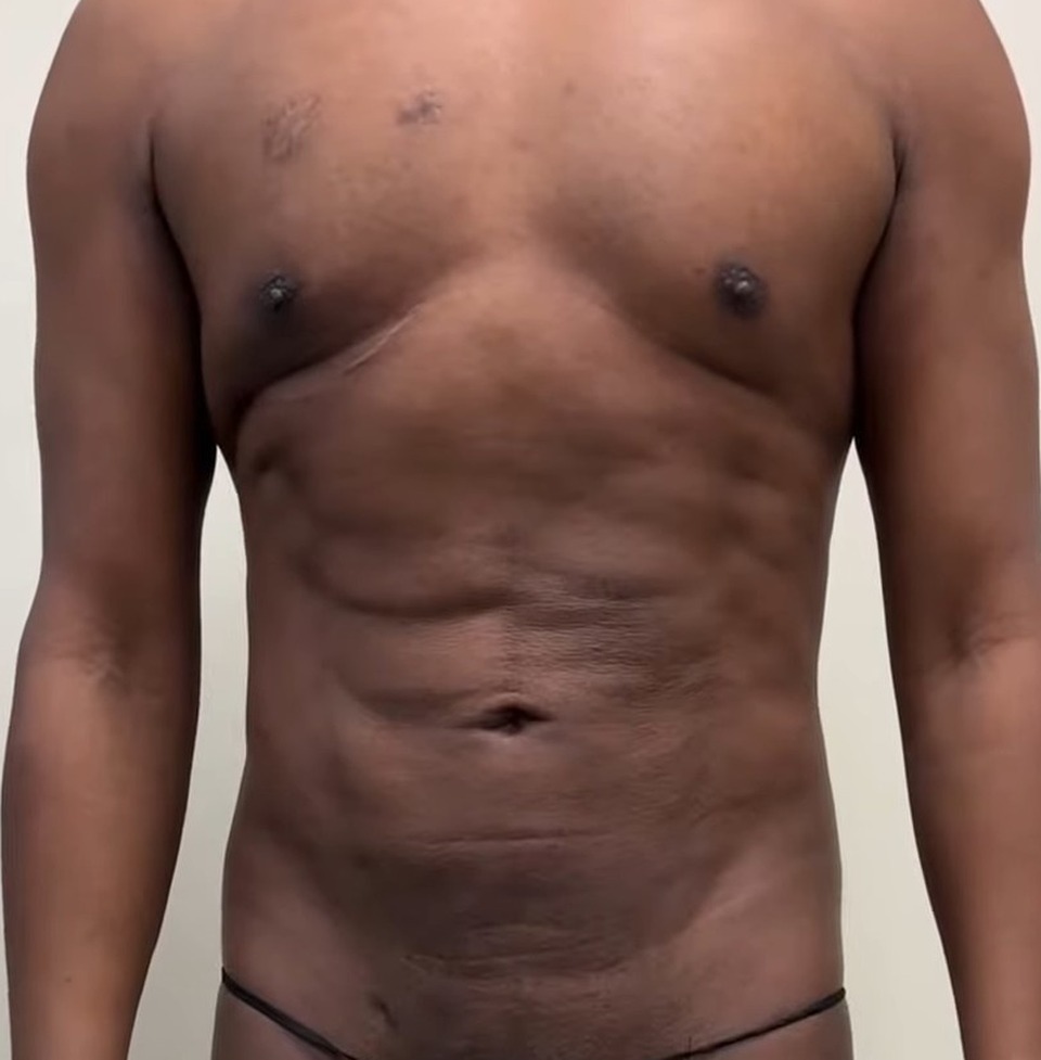 Before, Revision Body Sculpting For Men: How Dr. Emer Fixes Previous Liposuction That Missed The Mark | Dr. Jason Emer