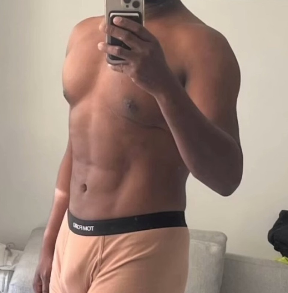 AFTER, Revision Body Sculpting For Men: How Dr. Emer Fixes Previous Liposuction That Missed The Mark | Dr. Jason Emer