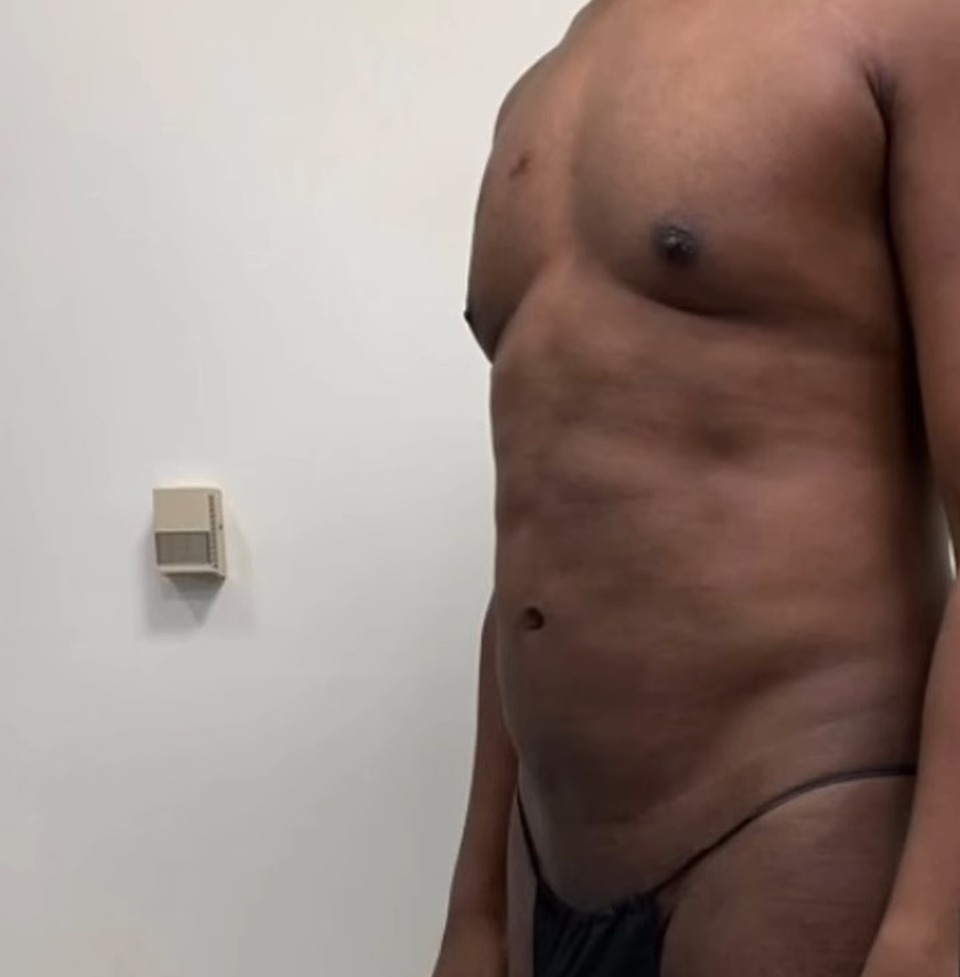 Before, Revision Body Sculpting For Men: How Dr. Emer Fixes Previous Liposuction That Missed The Mark | Dr. Jason Emer