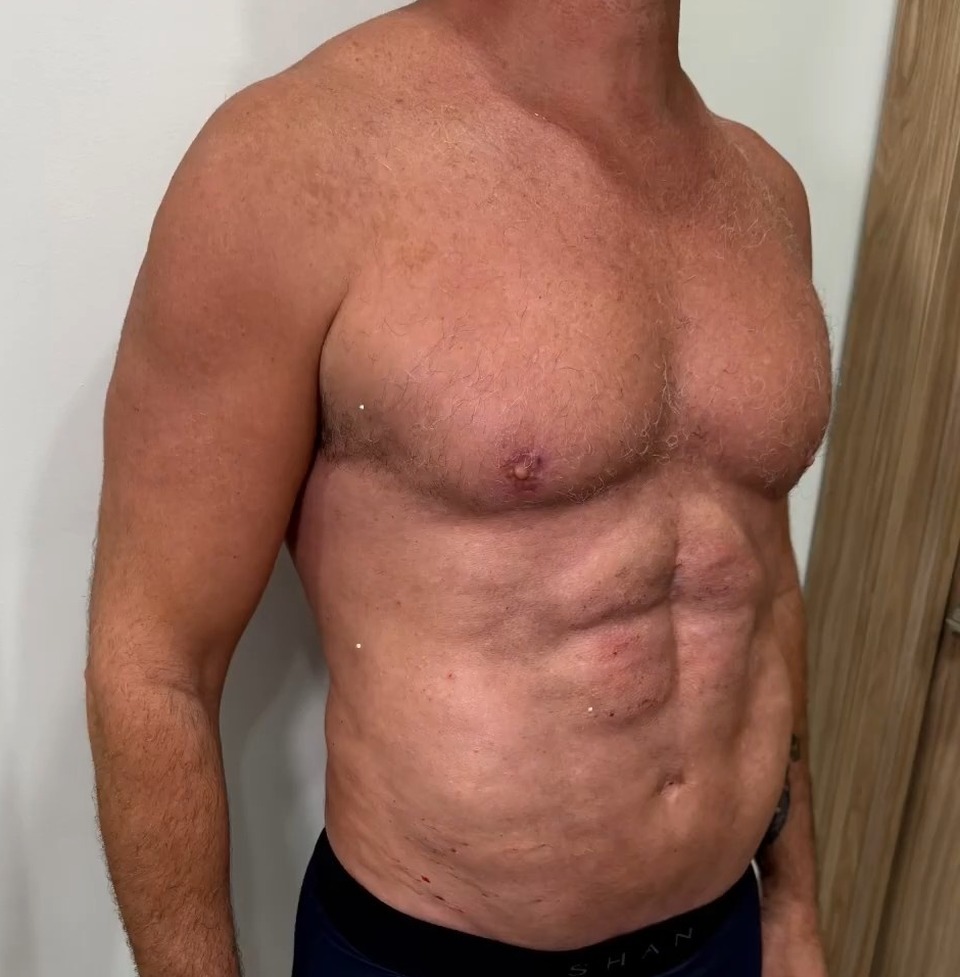 AFTER, Full Body Revision: MAXORIS Lipo, Chest Sculpting, Hernia Repair And Abs Enhancement In One Session | Dr. Jason Emer