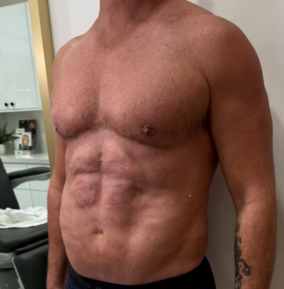 AFTER, Full Body Revision: MAXORIS Lipo, Chest Sculpting, Hernia Repair And Abs Enhancement In One Session | Dr. Jason Emer