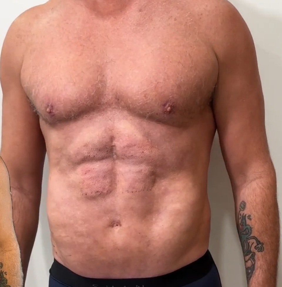 AFTER, Full Body Revision: MAXORIS Lipo, Chest Sculpting, Hernia Repair And Abs Enhancement In One Session | Dr. Jason Emer