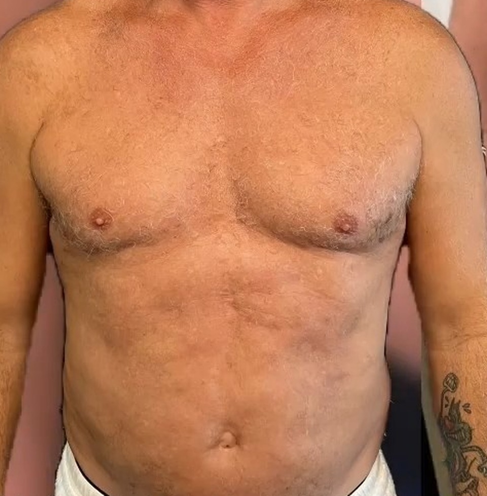 Before, Full Body Revision: MAXORIS Lipo, Chest Sculpting, Hernia Repair And Abs Enhancement In One Session | Dr. Jason Emer
