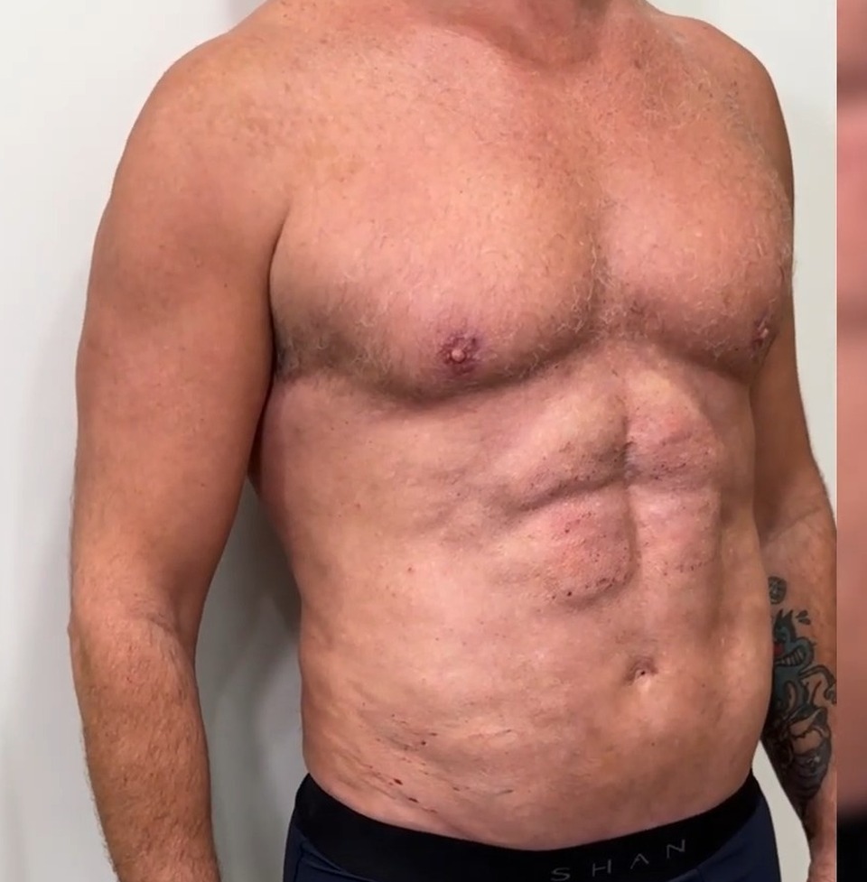 AFTER, Full Body Revision: MAXORIS Lipo, Chest Sculpting, Hernia Repair And Abs Enhancement In One Session | Dr. Jason Emer