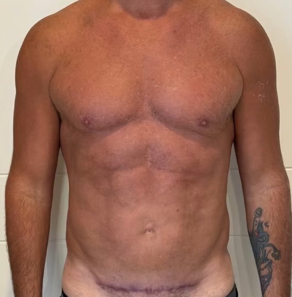 AFTER, Full Body Revision: MAXORIS Lipo, Chest Sculpting, Hernia Repair And Abs Enhancement In One Session | Dr. Jason Emer
