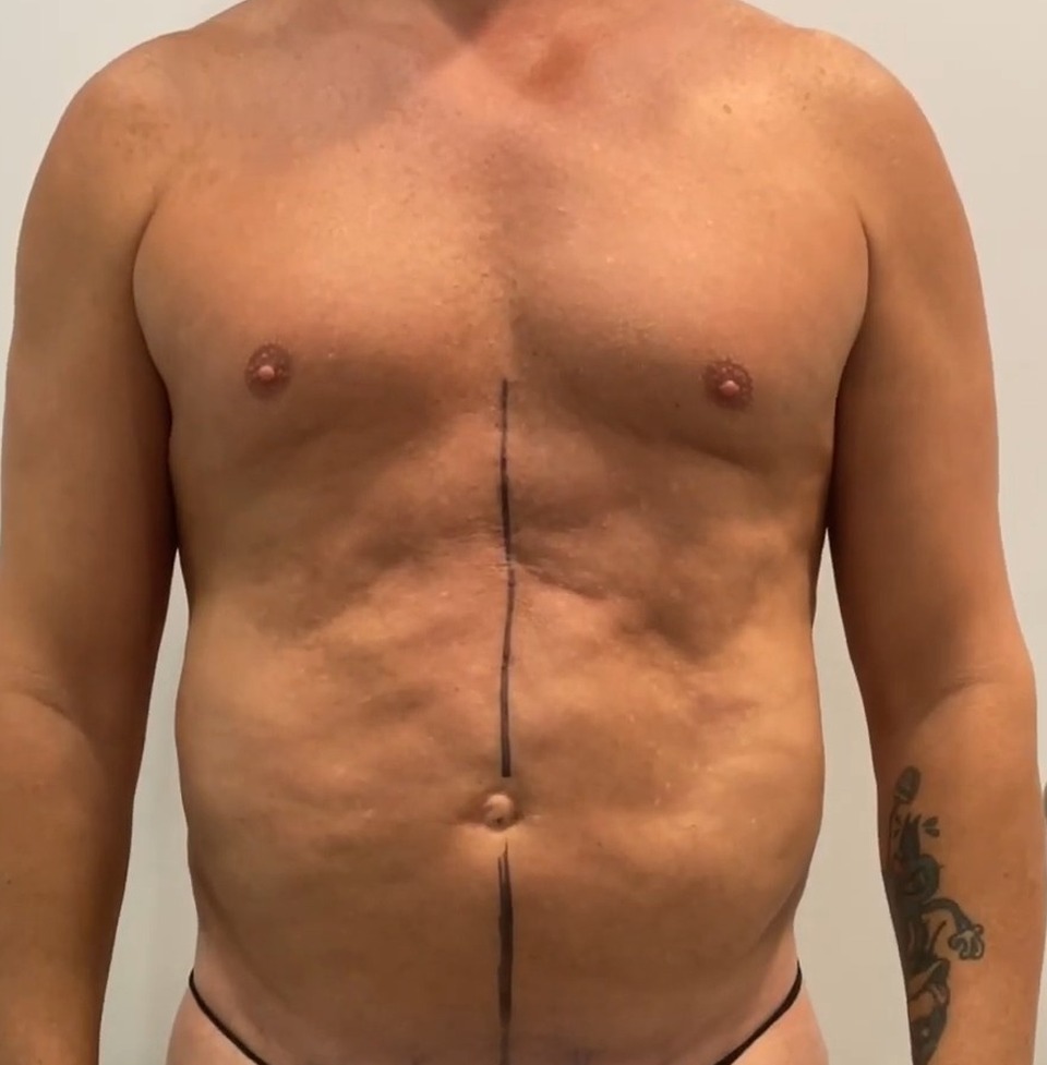 Before, Full Body Revision: MAXORIS Lipo, Chest Sculpting, Hernia Repair And Abs Enhancement In One Session | Dr. Jason Emer