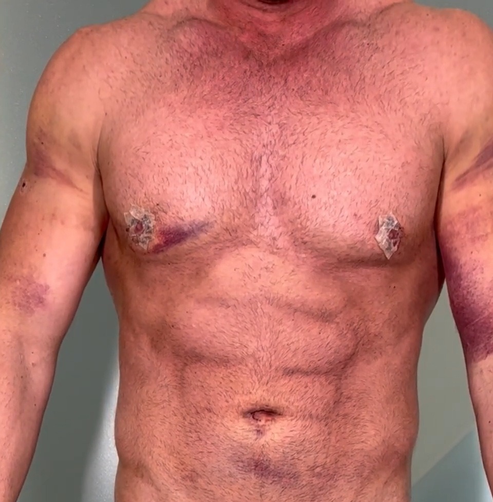WEEK 1, Chest sculpting and fat grafting