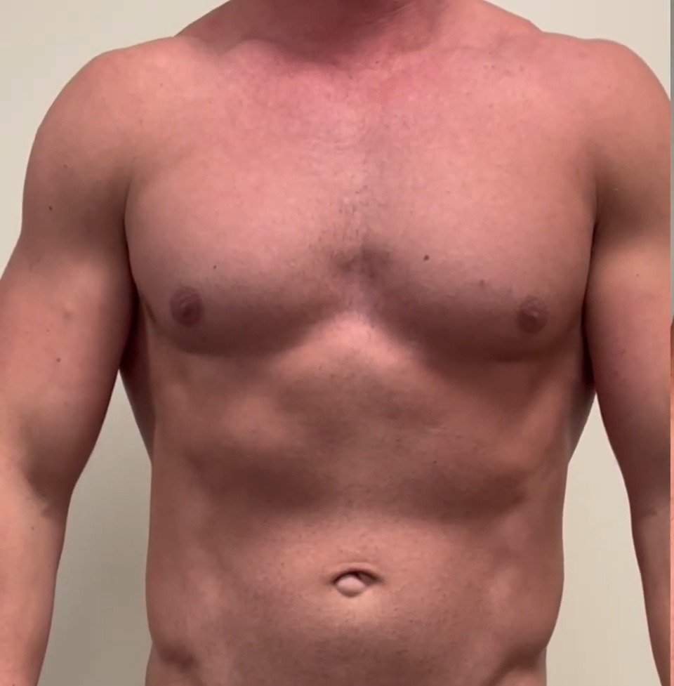 Before, Chest sculpting and fat grafting