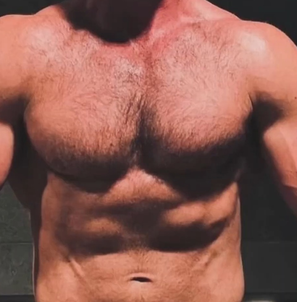 AFTER, Chest sculpting and fat grafting