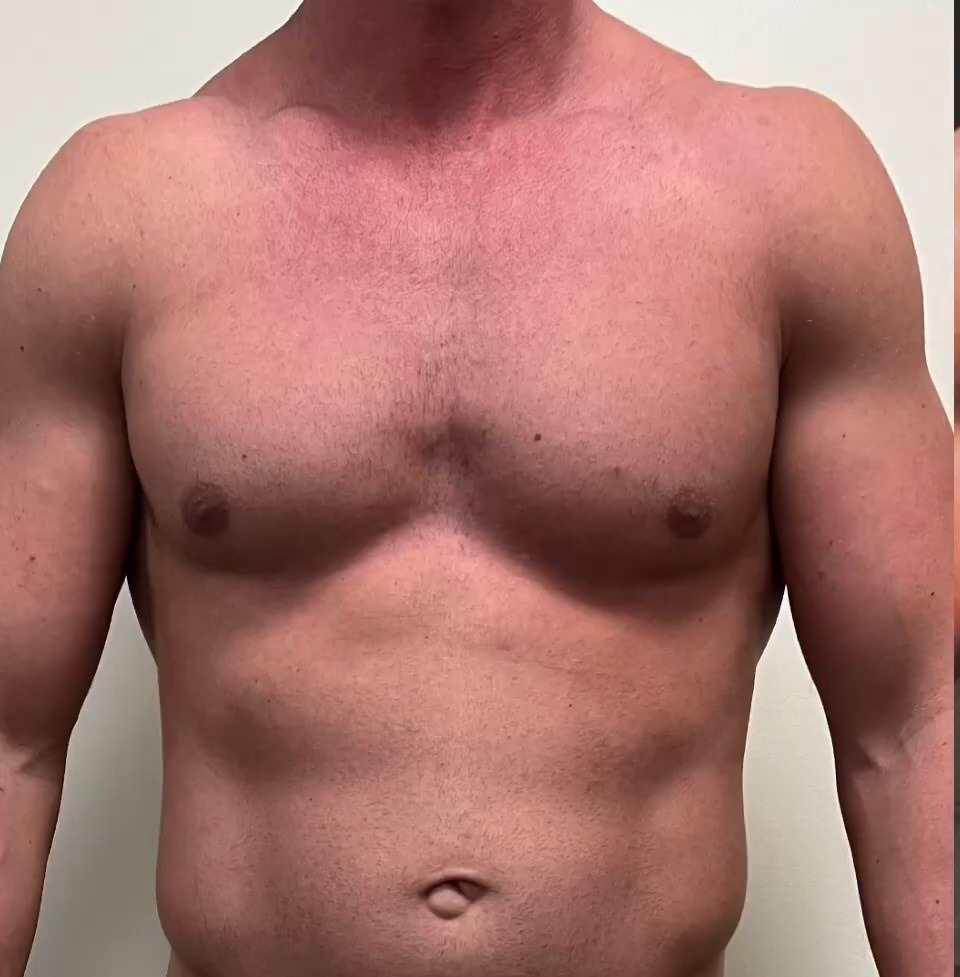Before, Chest sculpting and fat grafting