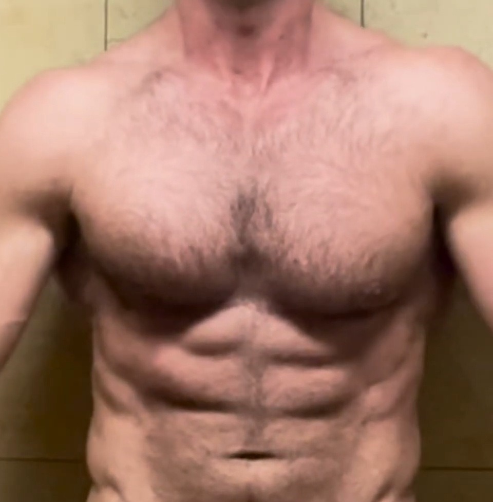 AFTER, Chest sculpting and fat grafting