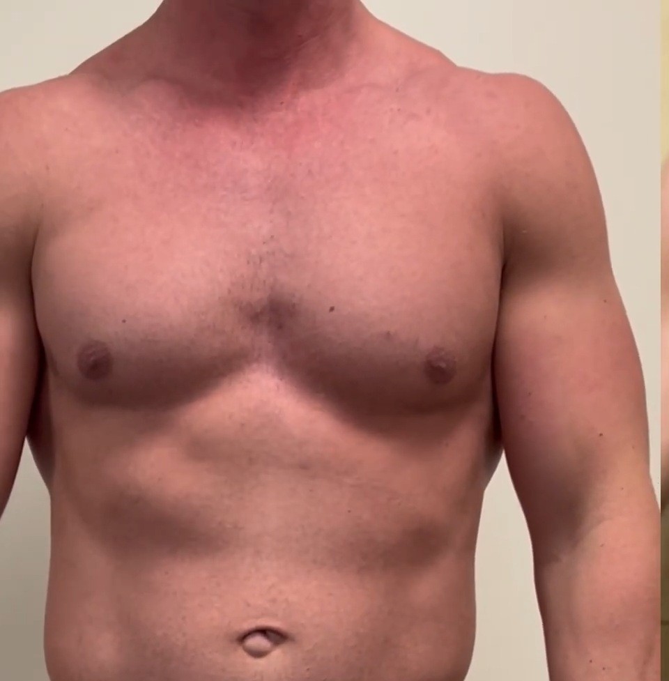 Before, Chest sculpting and fat grafting