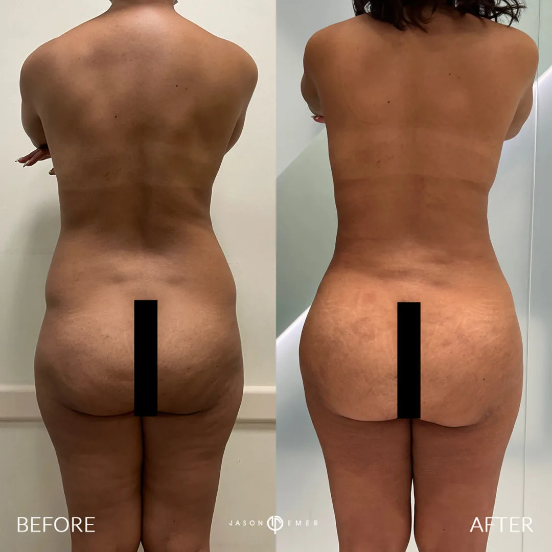 PUBLISHED PRACTICE COMPARISONS: Buttock volume. Practice caption: fat grafting to buttocks. This is a different patient from the hip-contour comparison.