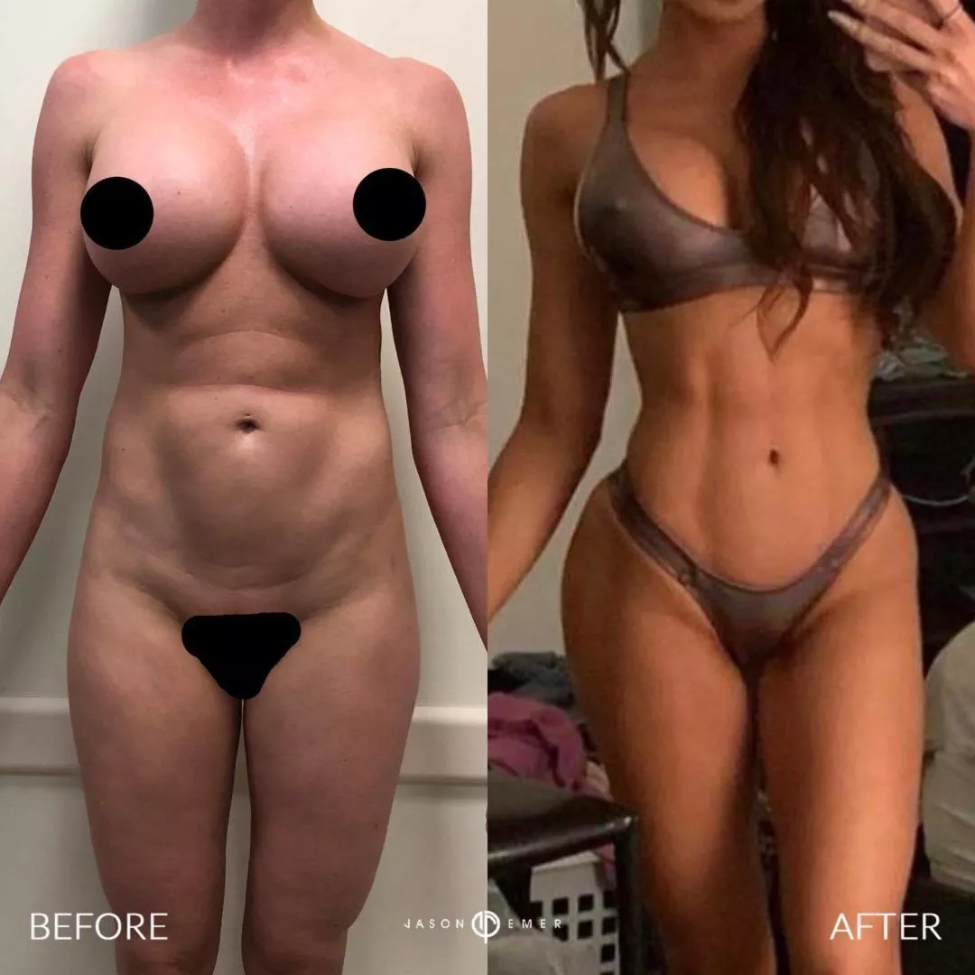 PUBLISHED PRACTICE COMPARISONS: Hip contour. Practice caption: fat grafting to hip dips. This photograph shows one combined case.