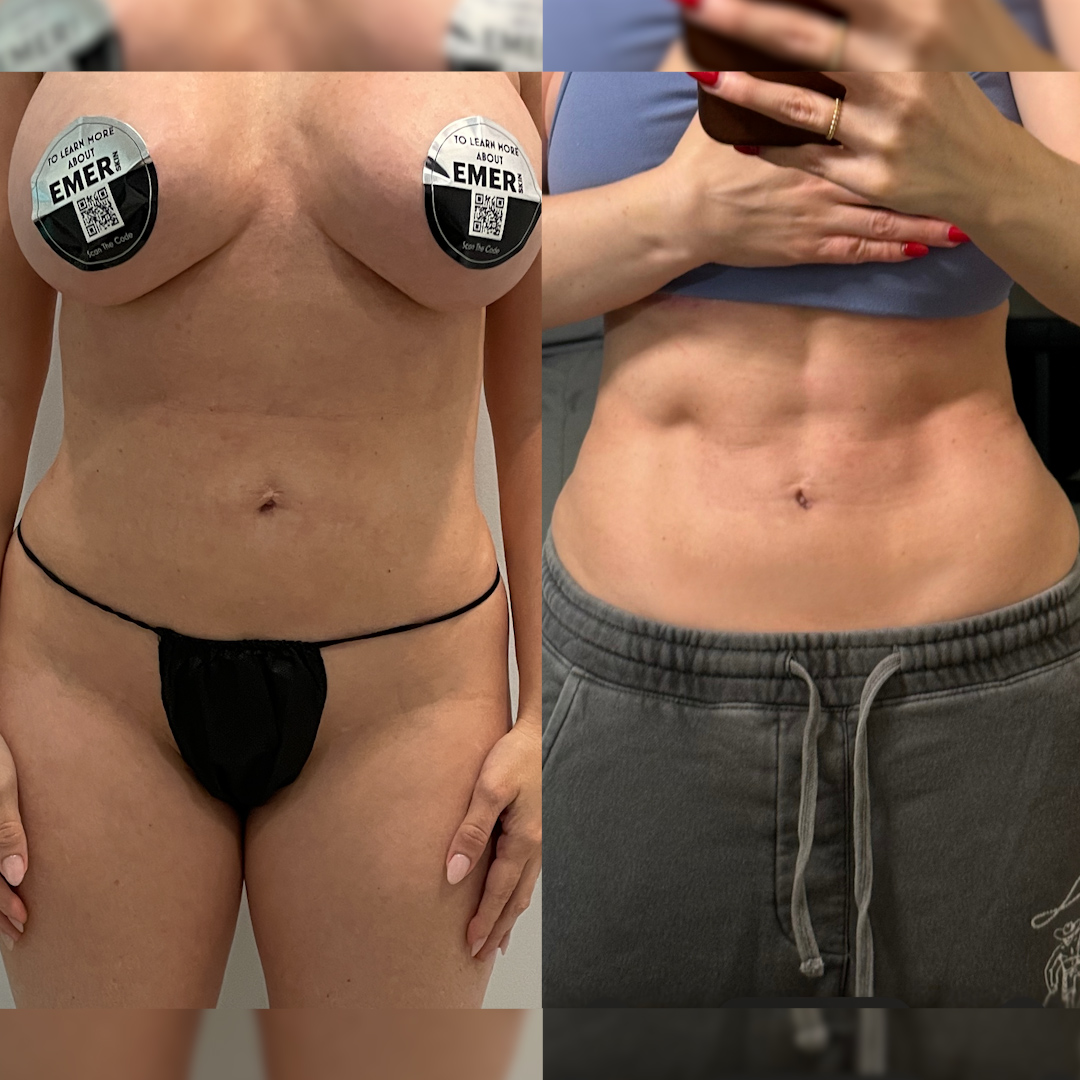 JESS / CELESTA · RE:WRITE: Comparison. Before surgery and a follow-up view; exact capture dates not shown. Original privacy covers retained.