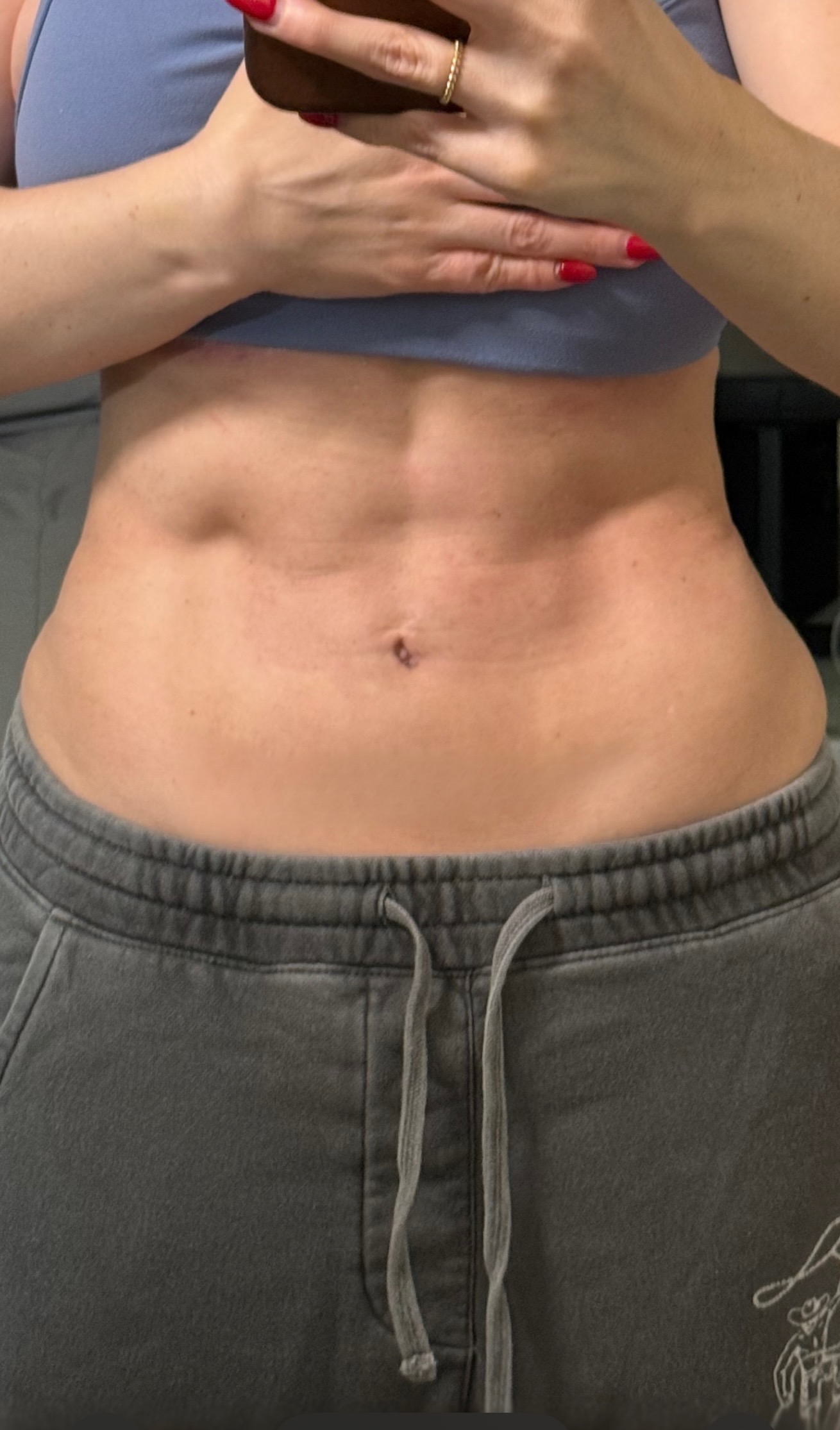JESS / CELESTA · RE:WRITE: Patient update. Patient-supplied follow-up after the December 2024 combined revision. The setting and pose differ from clinic photographs.