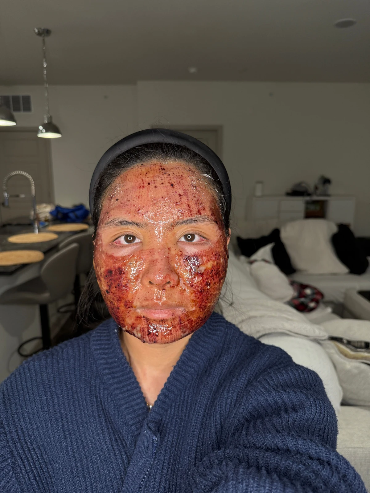 KIMBERLY / OCTOBER 2025: Day 1. Early recovery after combined scar treatment. Redness and healing changes are visible.