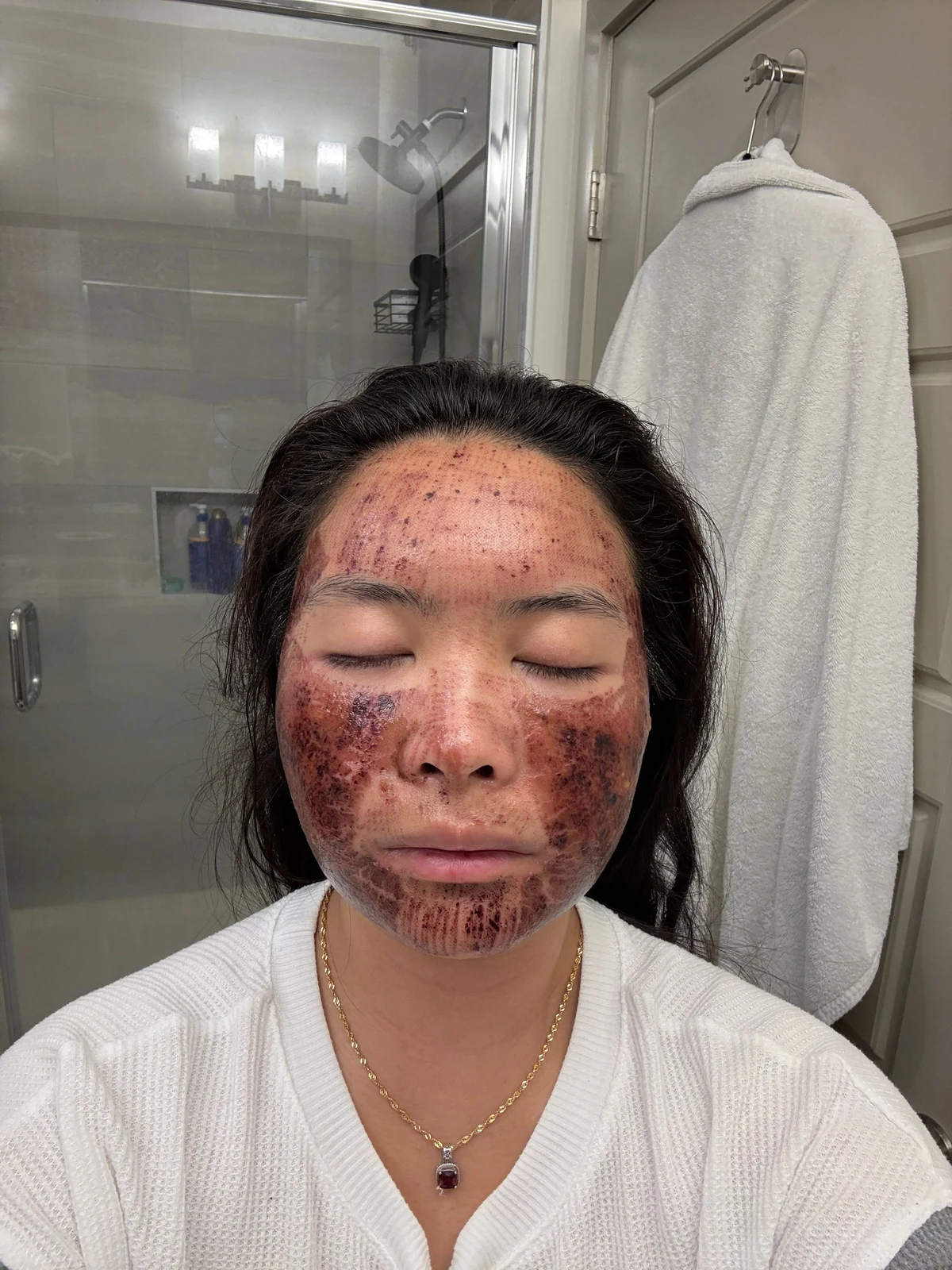 KIMBERLY / OCTOBER 2025: Day 3. Early recovery after combined scar treatment. Redness and healing changes are visible.