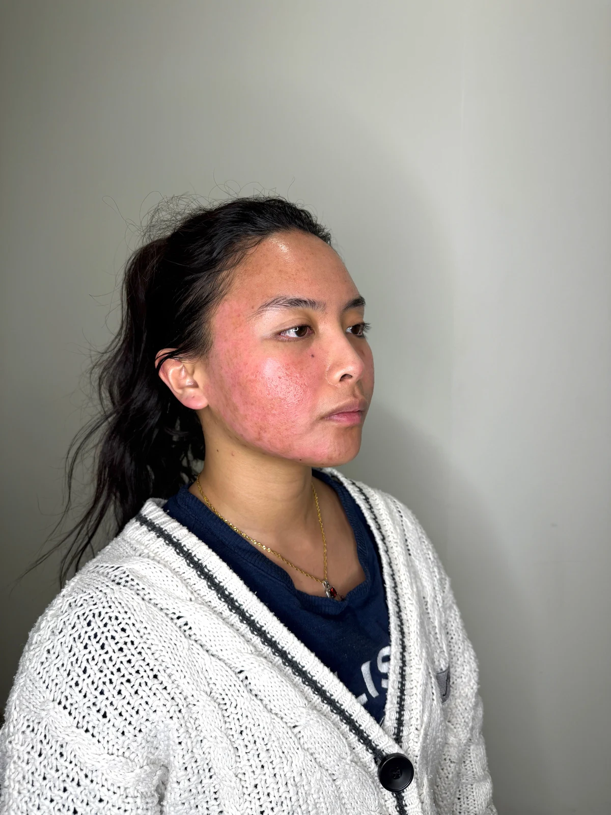 KIMBERLY / OCTOBER 2025: Day 5. Early recovery after combined scar treatment. Redness and healing changes are visible.