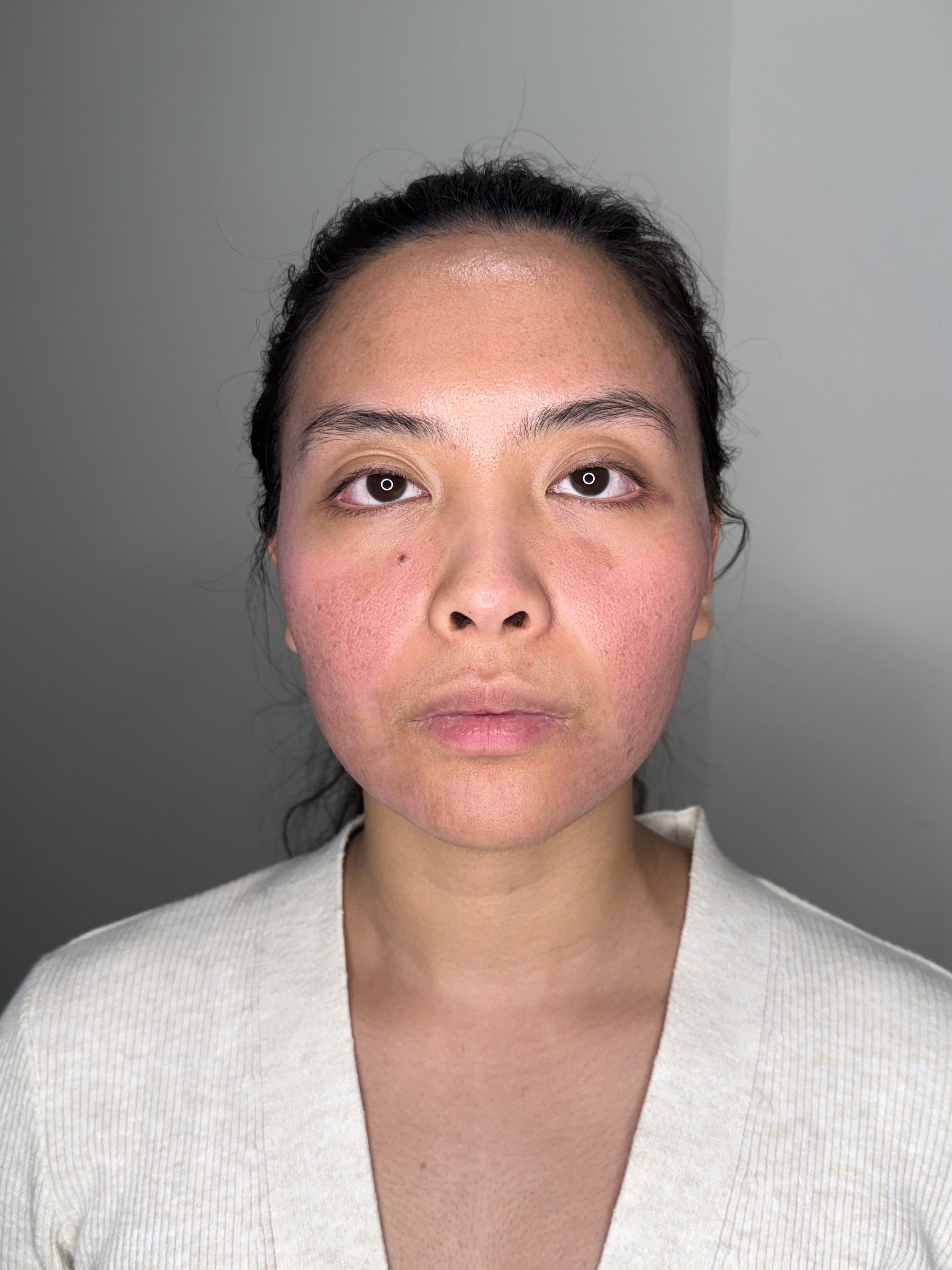 KIMBERLY / OCTOBER 2025: Day 8. Early recovery after combined scar treatment. Redness and healing changes are visible.